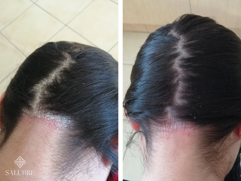 psoriasis before after 3