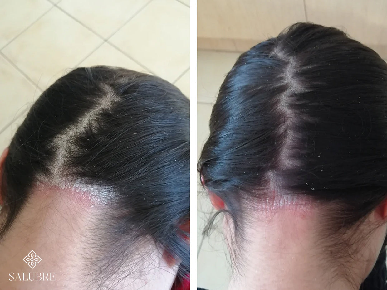 scalp-psoriasis