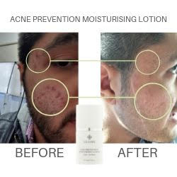 Using acne prevention moisturising lotion before and after treatment images