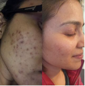 Customer case study before and after acne treatment